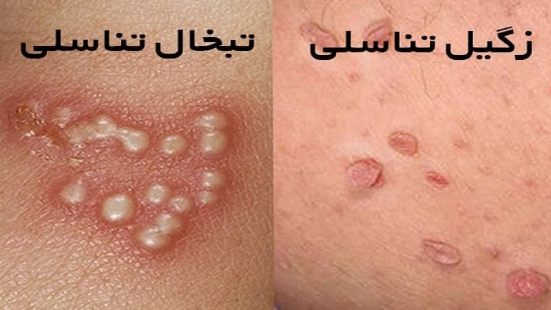 تفاوت زگیل تناسلی و تبخال تناسلی